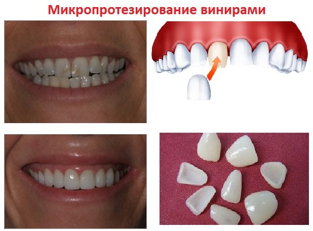 микропротезирование зубные виниры