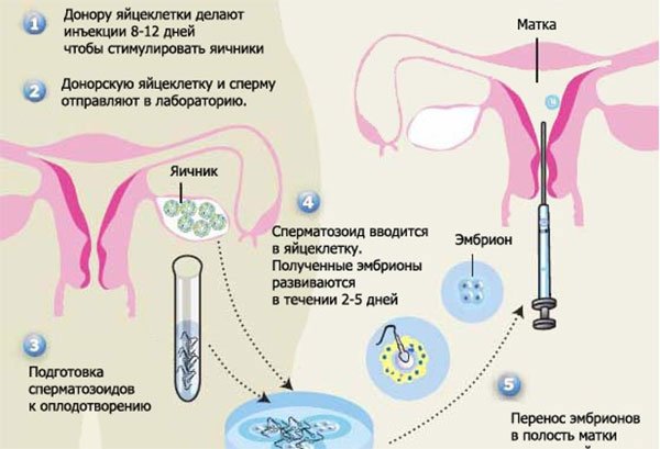 донация яйцеклетки