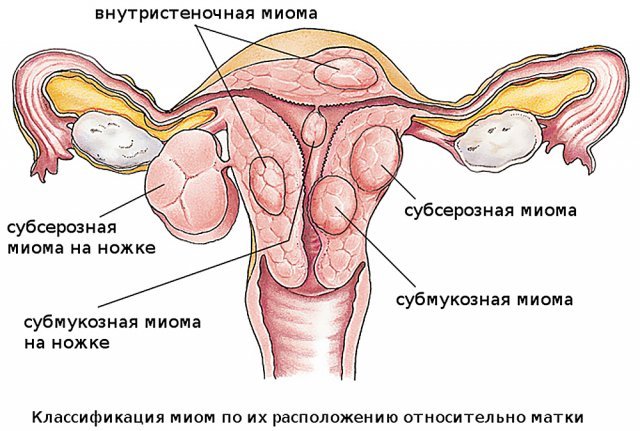 Міома матки
